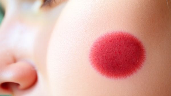 Top 5 faits surprenants sur les cicatrices chéloïdes